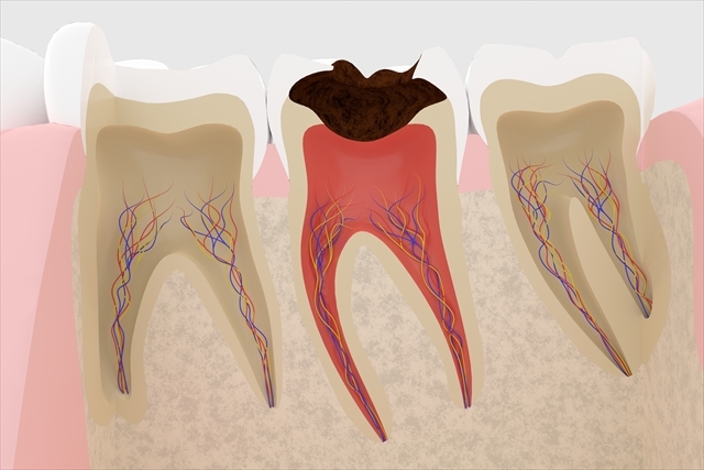 歯根端切除術について