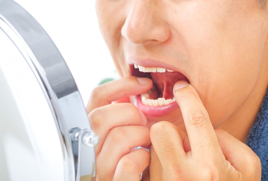 根管治療でひびがある歯を保存できる？原因・治療法も解説
