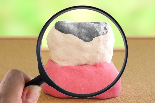 根管治療を行ってもむし歯が再発しやすい理由